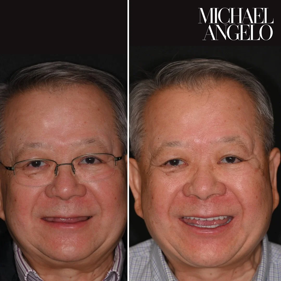 ๐
๐ฎ๐ฅ๐ฅ-๐๐จ๐ฎ๐ญ๐ก ๐๐๐ก๐๐๐ข๐ฅ๐ข๐ญ๐๐ญ๐ข๐จ๐ง (๐๐ฉ๐ฉ๐๐ซ + ๐๐จ๐ฐ๐๐ซ)
This gentleman came in with severely worn-down teeth — almost no space between his upper and lower arches, and barely any room for his tongue to rest.
We decided to re