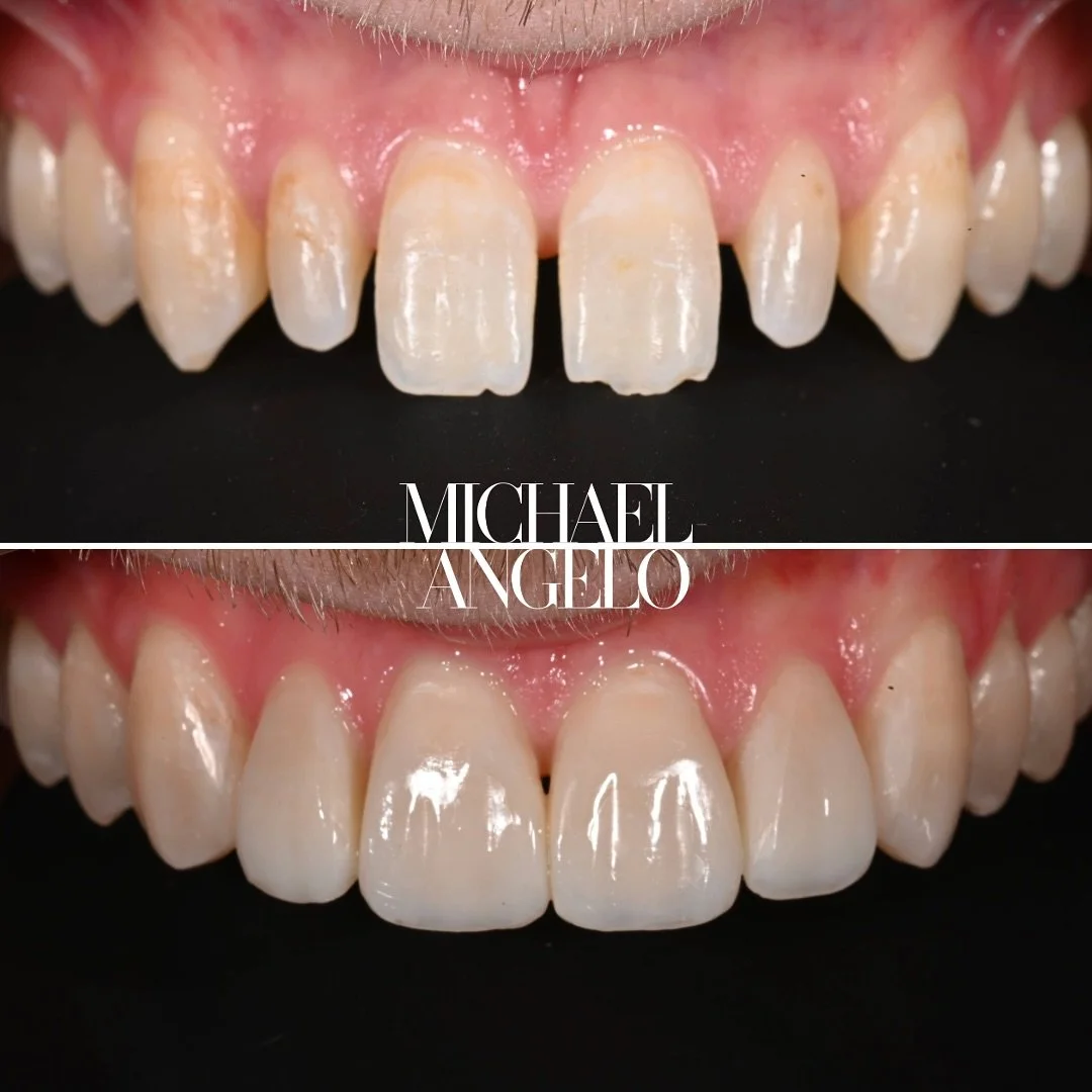 • ๐ ๐๐ฅ๐จ๐ฌ๐๐ซ ๐ฅ๐จ๐จ๐ค ๐๐ญ ๐ญ๐ก๐ข๐ฌ ๐๐๐๐ฎ๐ญ๐ข๐๐ฎ๐ฅ ๐ญ๐ซ๐๐ง๐ฌ๐๐จ๐ซ๐ฆ๐๐ญ๐ข๐จ๐ง
• Zero Drilling. 
• Not the veneers you know. 
• Fly in → 2.5 days → Start to finish.
Send me a DM with your smile photo for a per