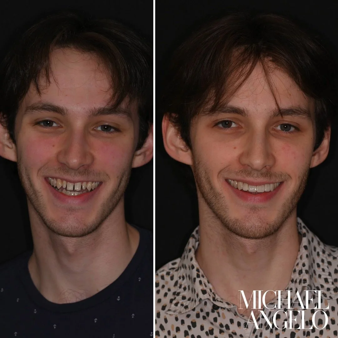 Closed gaps, kept the natural shade, and transformed this smile with composite veneers — all in a single visit.
No drilling, just an additive approach that preserves the natural teeth.
Key details:
	• Location: Redmond, WA (Seattle area)