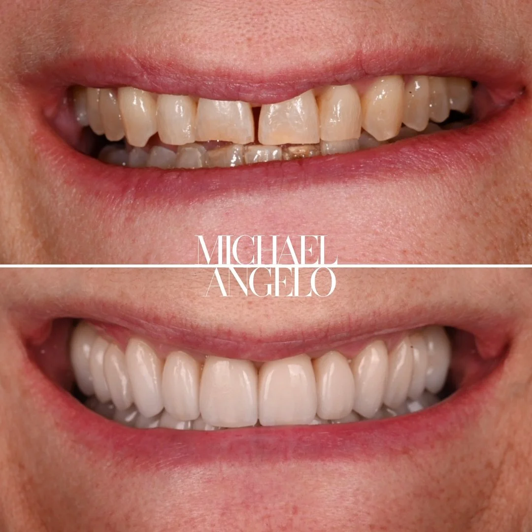 A closer look at this full mouth transformation.
We chose the right zirconia shade and translucency to mimic the natural characteristics of a youthful smile — harmonizing beautifully with her facial features. Subtle, balanced, and life-like fro