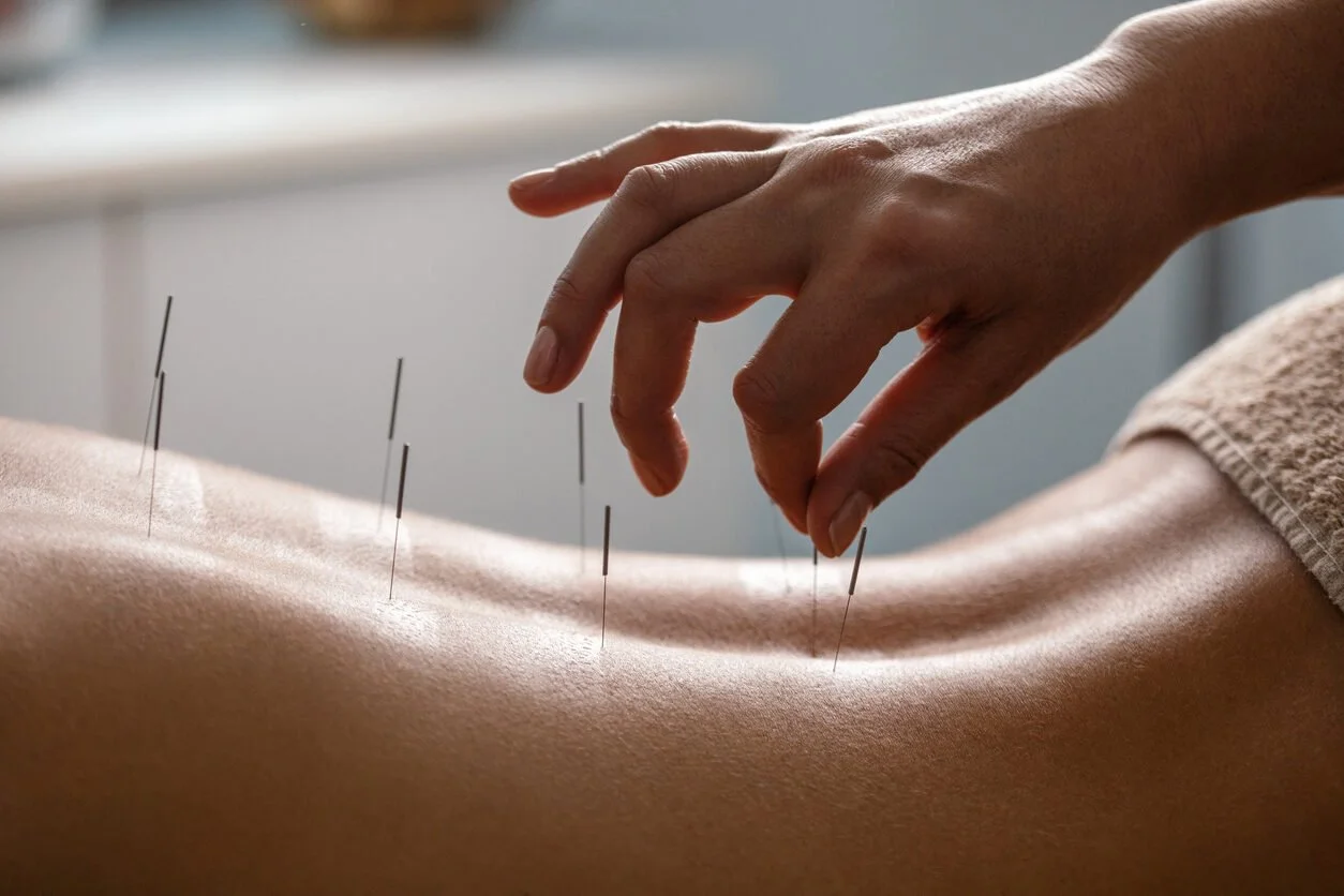 Acupuncture & Dry Needling