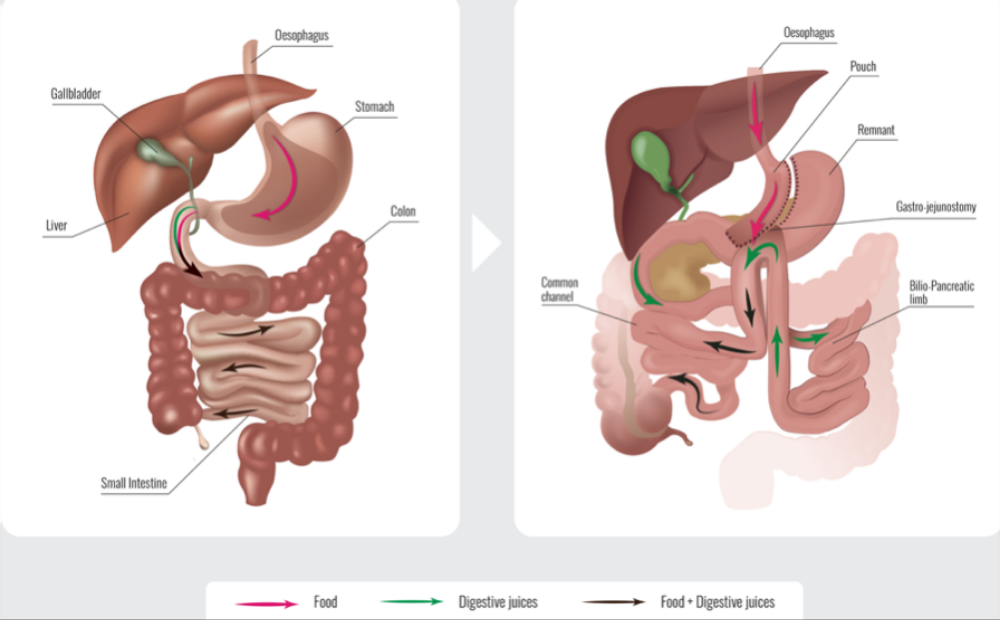 Diagram of human digestive system showing path of food and digestive juices through the stomach, small intestine, colon, and liver, with labels for organs like esophagus, gallbladder, pancreas, and common channel.