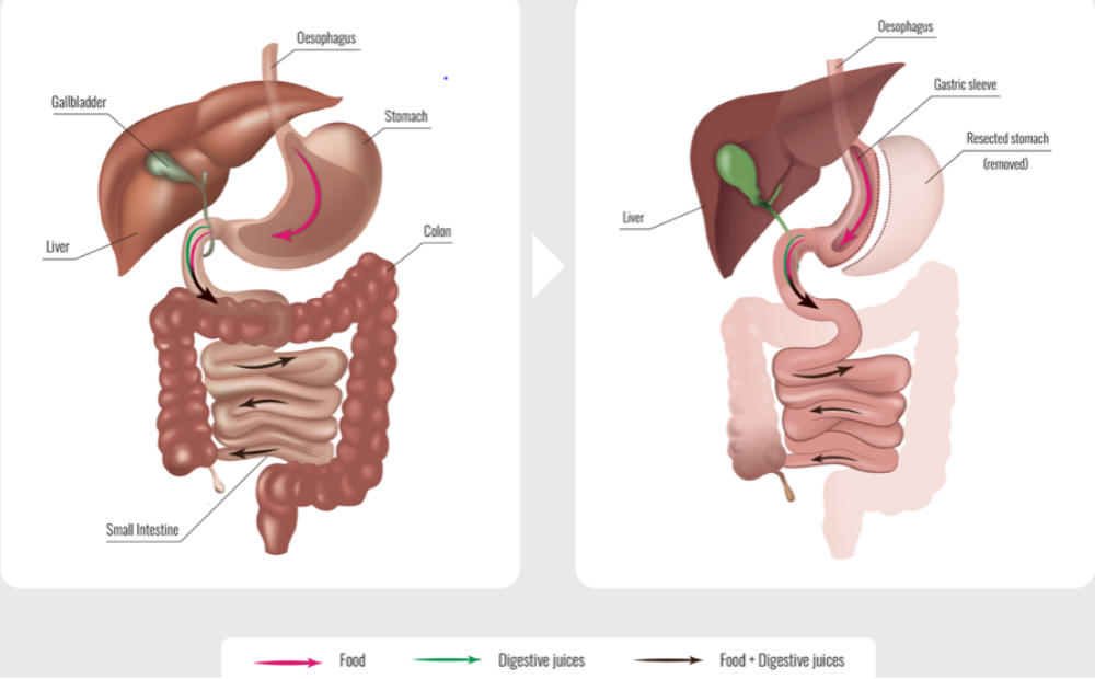 Diagram showing the process of food digestion from the stomach to the small intestine, including the liver, gallbladder, esophagus, and the removal of the stomach for some steps.