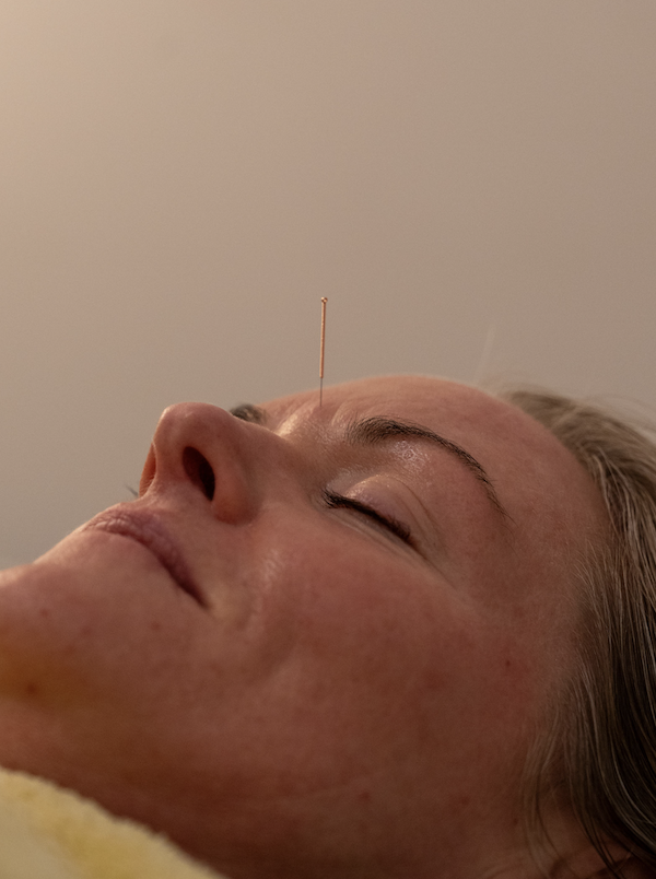 Gentle cosmetic and stress-relief acupuncture at Port Melbourne Traditional Chinese Medicine, South Melbourne and Port Melbourne clients.