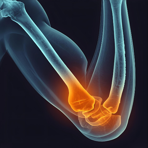 X-ray image of a forearm showing a fracture in the radius and ulna bones highlighted in orange.