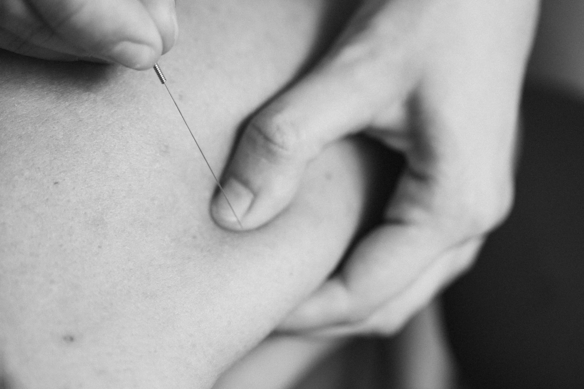 Persona recibiendo una aguja para acupuntura en la espalda.