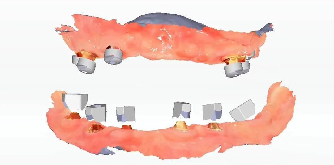 IPG Mode: For All-on-X and implant cases