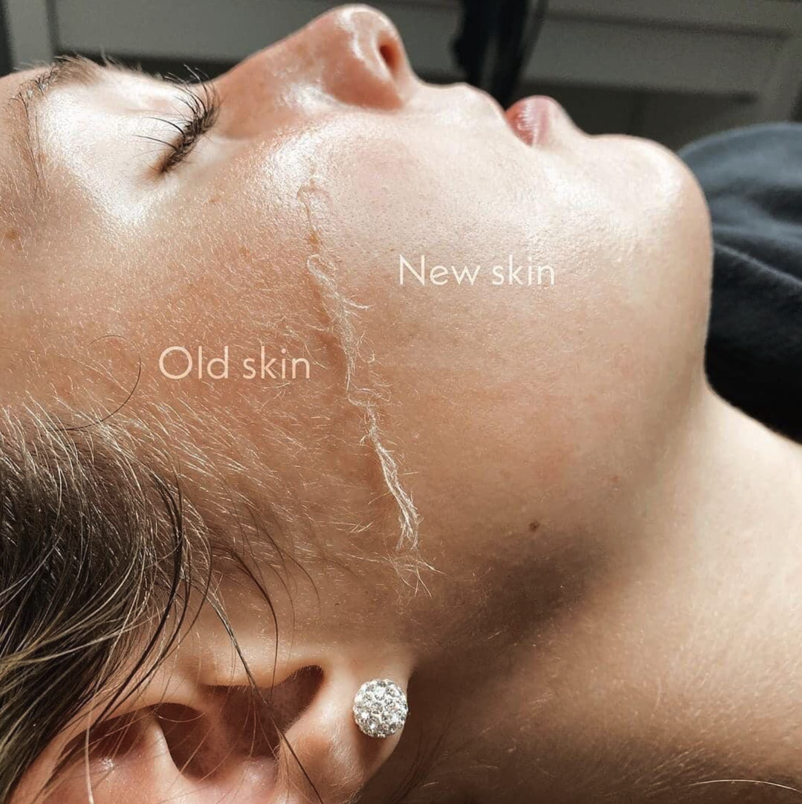 Close-up of a woman's face showing a comparison of old skin with visible wrinkles and new skin that appears smoother, with text labels 'Old skin' and 'New skin'.