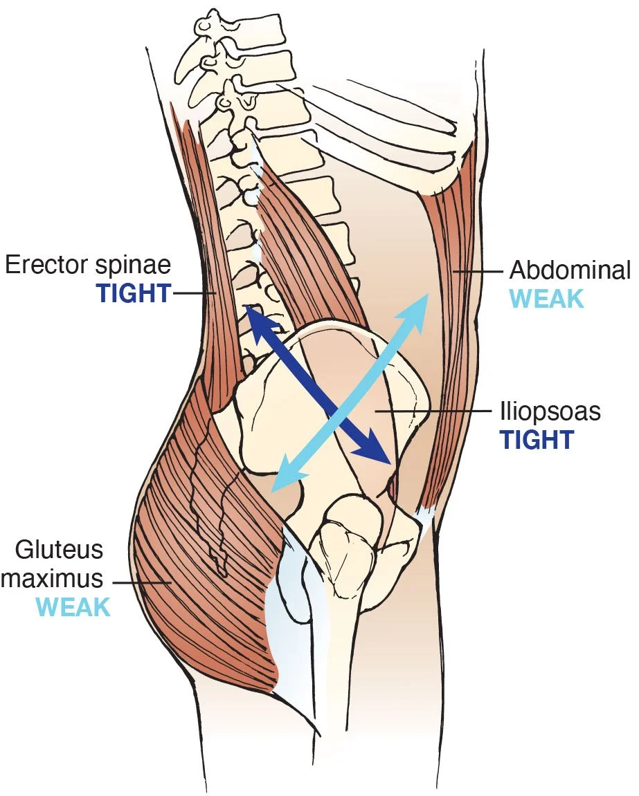 An anatomical illustration of the lower back and pelvis showing muscle groups, with labels indicating which muscles are tight or weak. The erector spinae and iliopsoas muscles are marked as tight, while the abdominal muscles and gluteus maximus are marked as weak.
