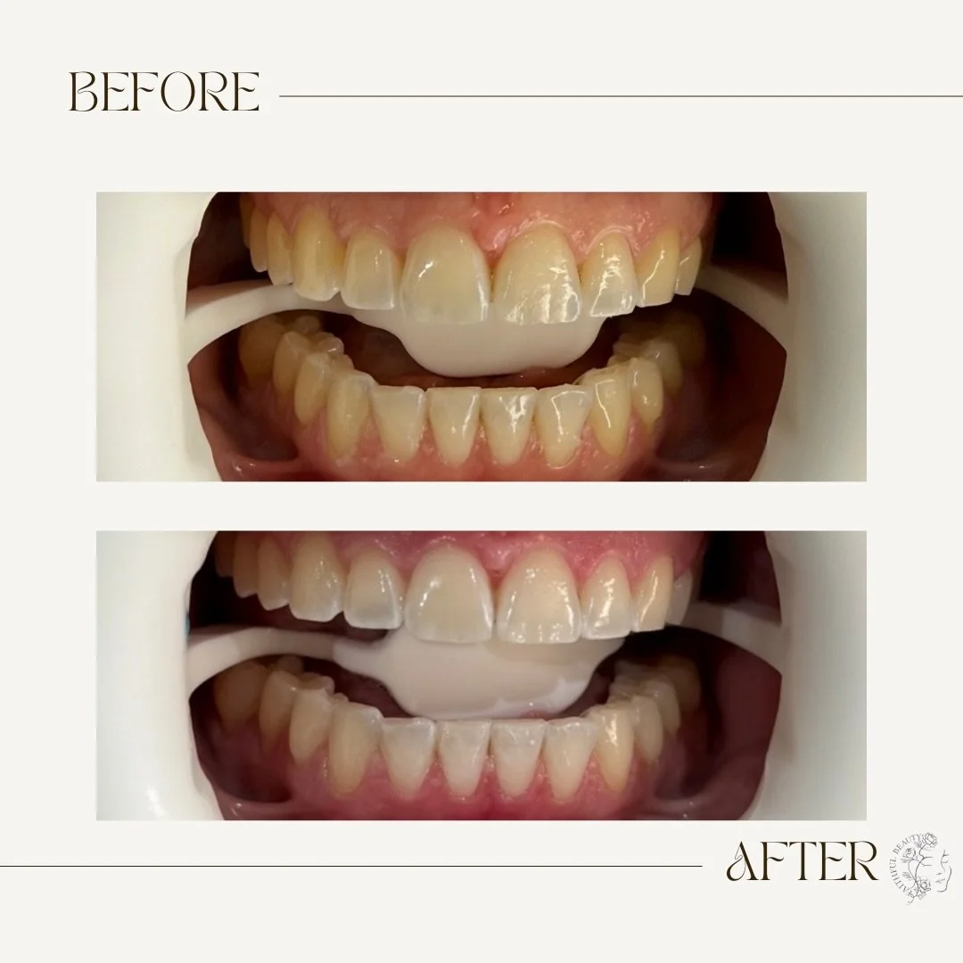 ✨ Elevate Your Smile ✨

Experience luxury teeth whitening at Faithful Beauty  where refinement meets results.
A brighter, more radiant smile in a serene, elevated setting.

For those who expect excellence.

 🌿Faithful Beauty
📍 Woodstock 
📞 519-320
