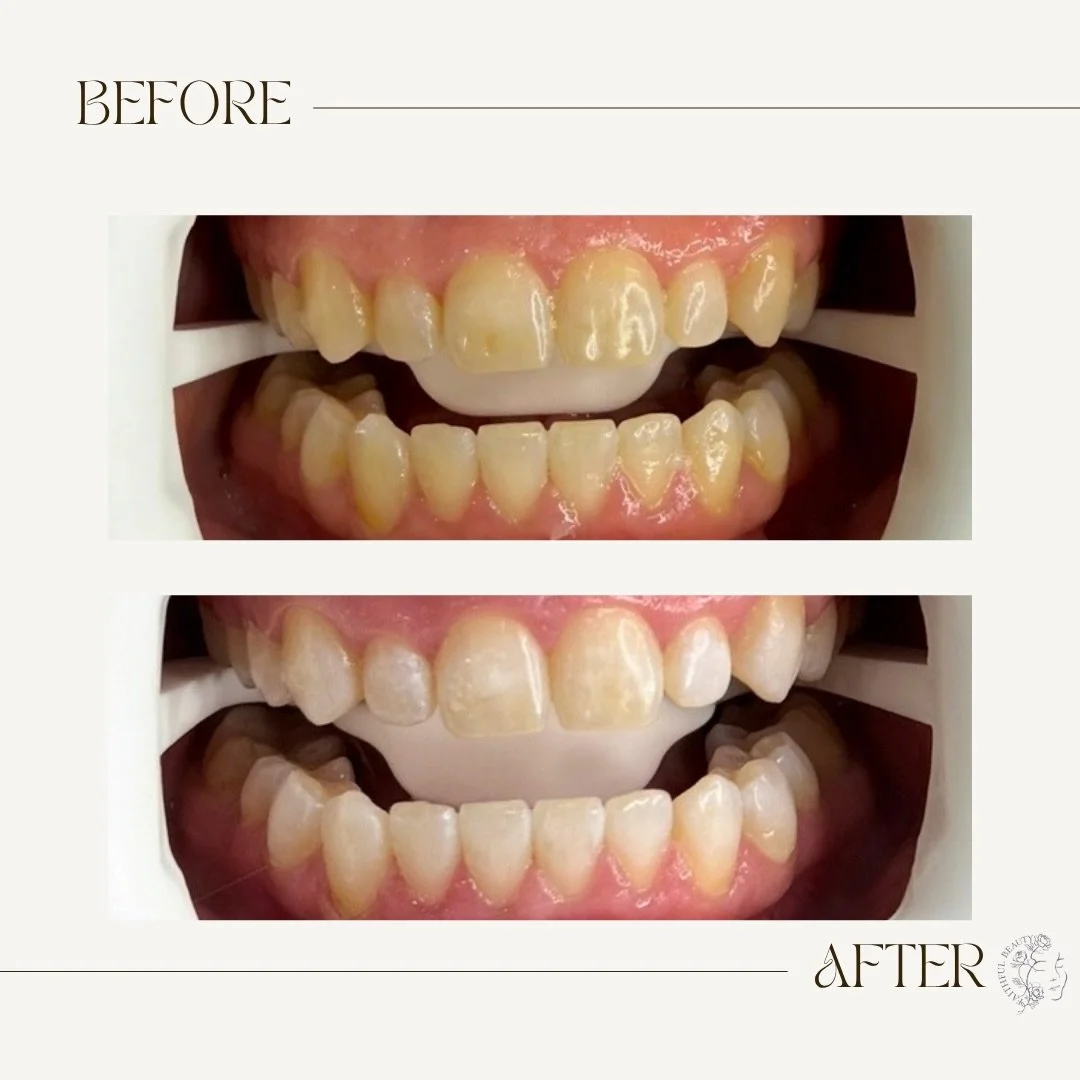 Teeth whitening session✨
This client only did one session! 

🌿Faithful Beauty
📍 Woodstock 
📞 519-320-6650
📧 Faithfulbeauty@hotmail.com
🌐 Www.faithfulbeauty.ca

#teethwhitening #teethwhiteningspecialist #smile #confidence #brightersmile