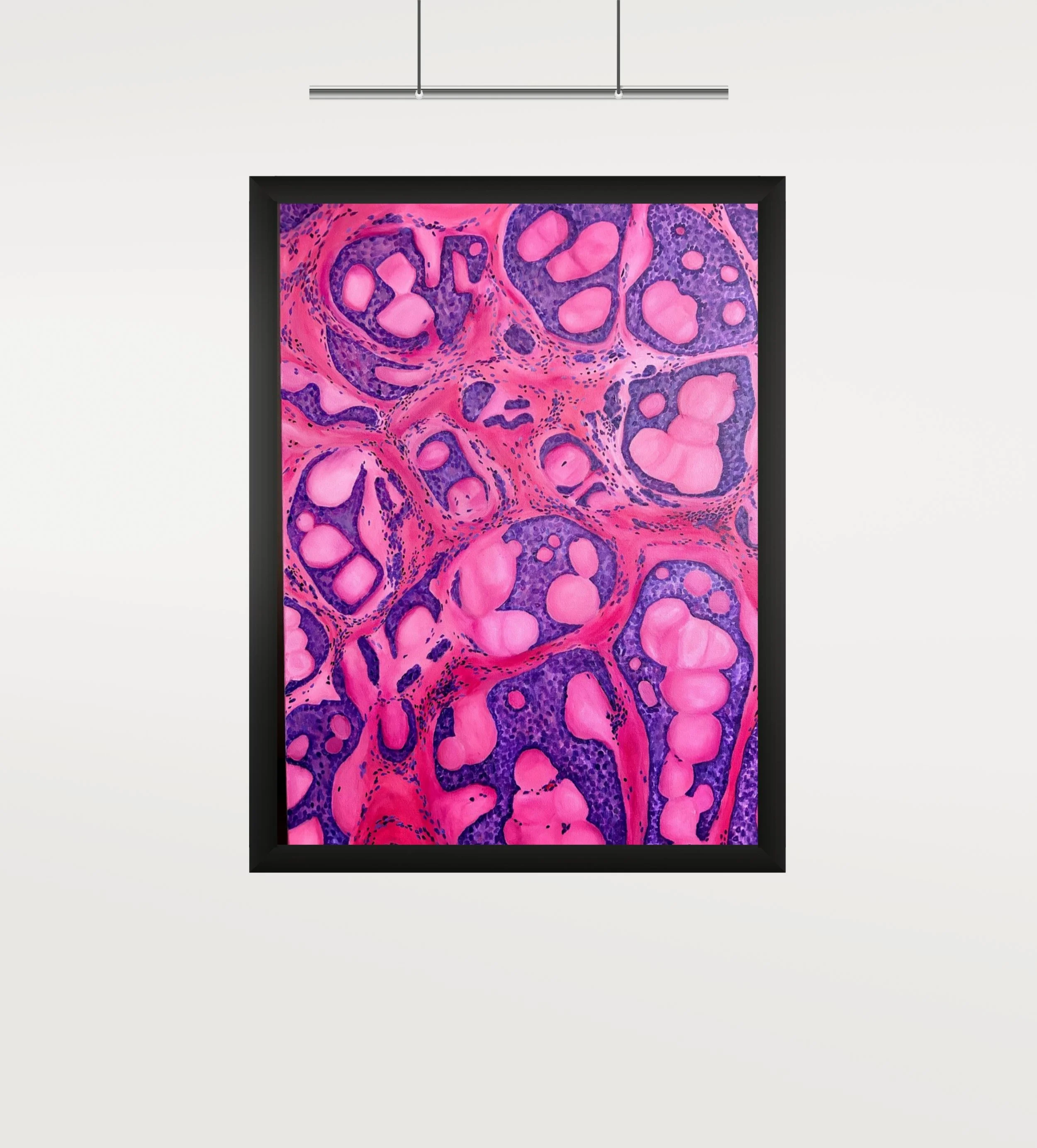 Ovarian Tumor Art Print