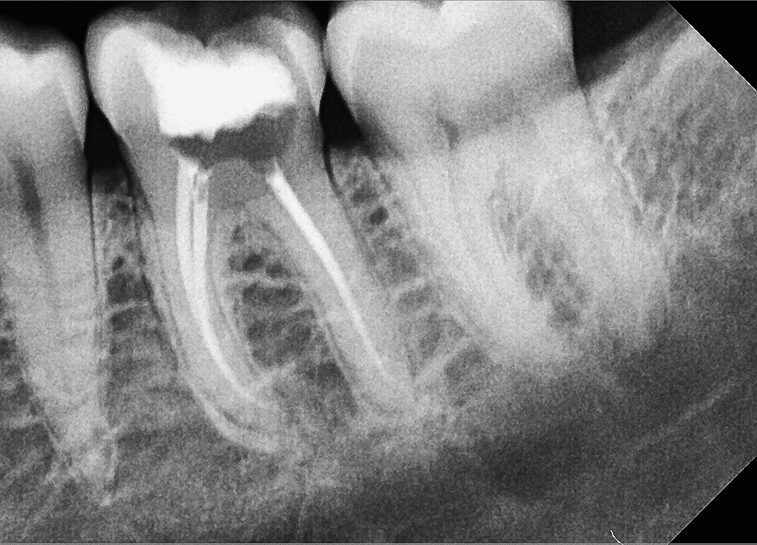 Endodoncia / Root canal