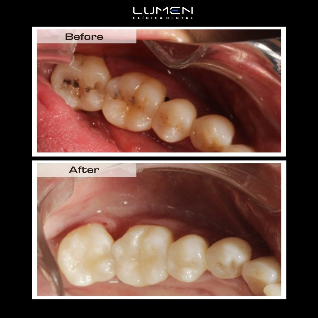 Remoci&oacute;n de caries y colocaci&oacute;n de resinas en sector inferior.
Get your smile back!🔥