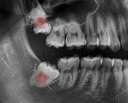 Wisdom teeth, roots, fractures.