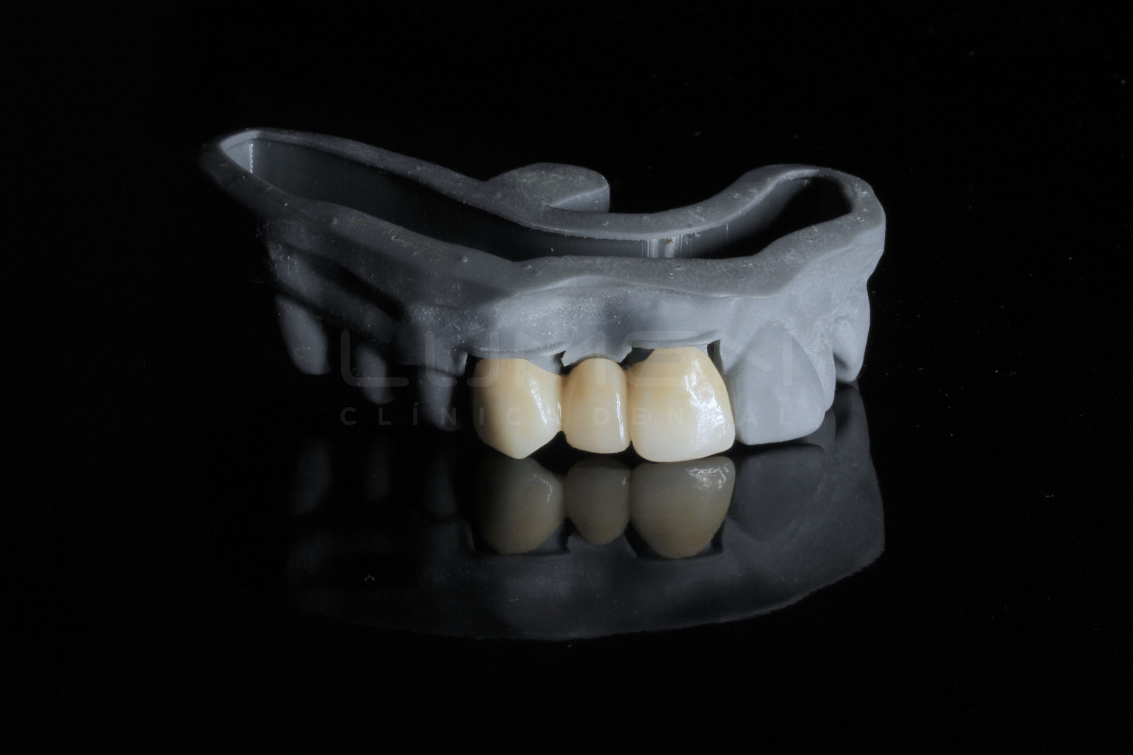 Crowns / dentures / Partials