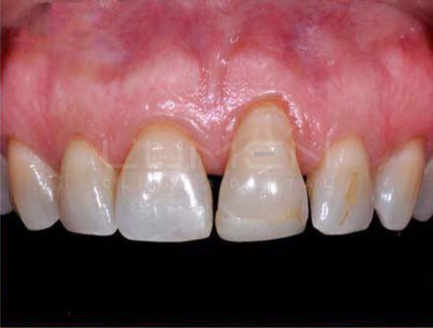 Gums/ Bone loss