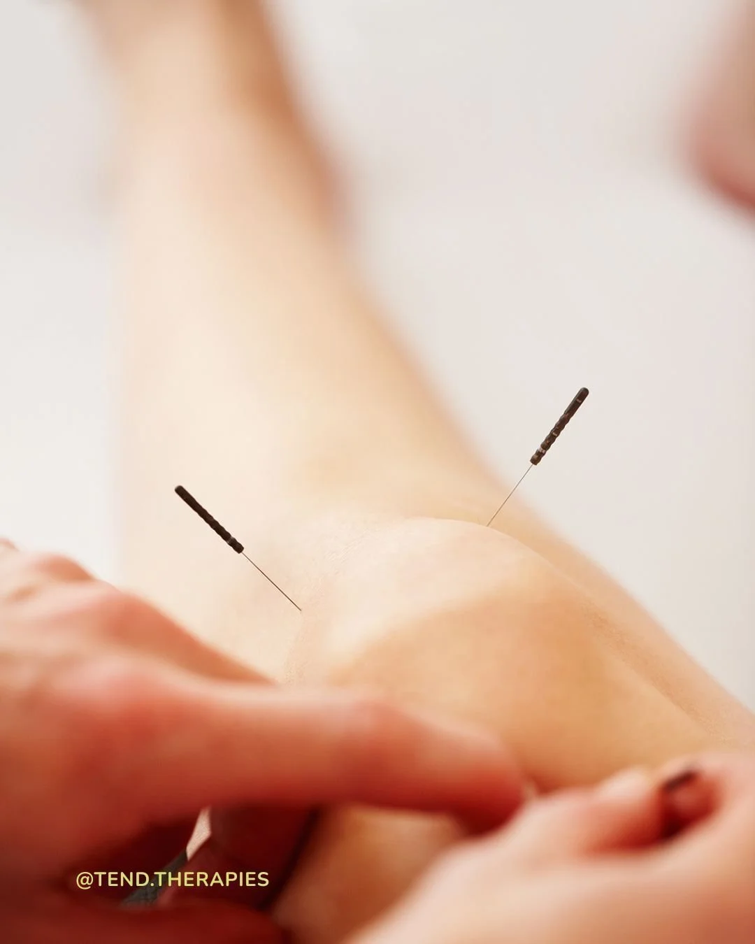 Struggling with back, neck, or joint pain? Acupuncture isn&rsquo;t just ancient, it&rsquo;s evidence-based.

🎯 Reduces Inflammation- Acupuncture lowers pro-inflammatory markers like TNF-&alpha; and IL-6. (Vickers et al., J Pain, 2018)
🎯  Releases N