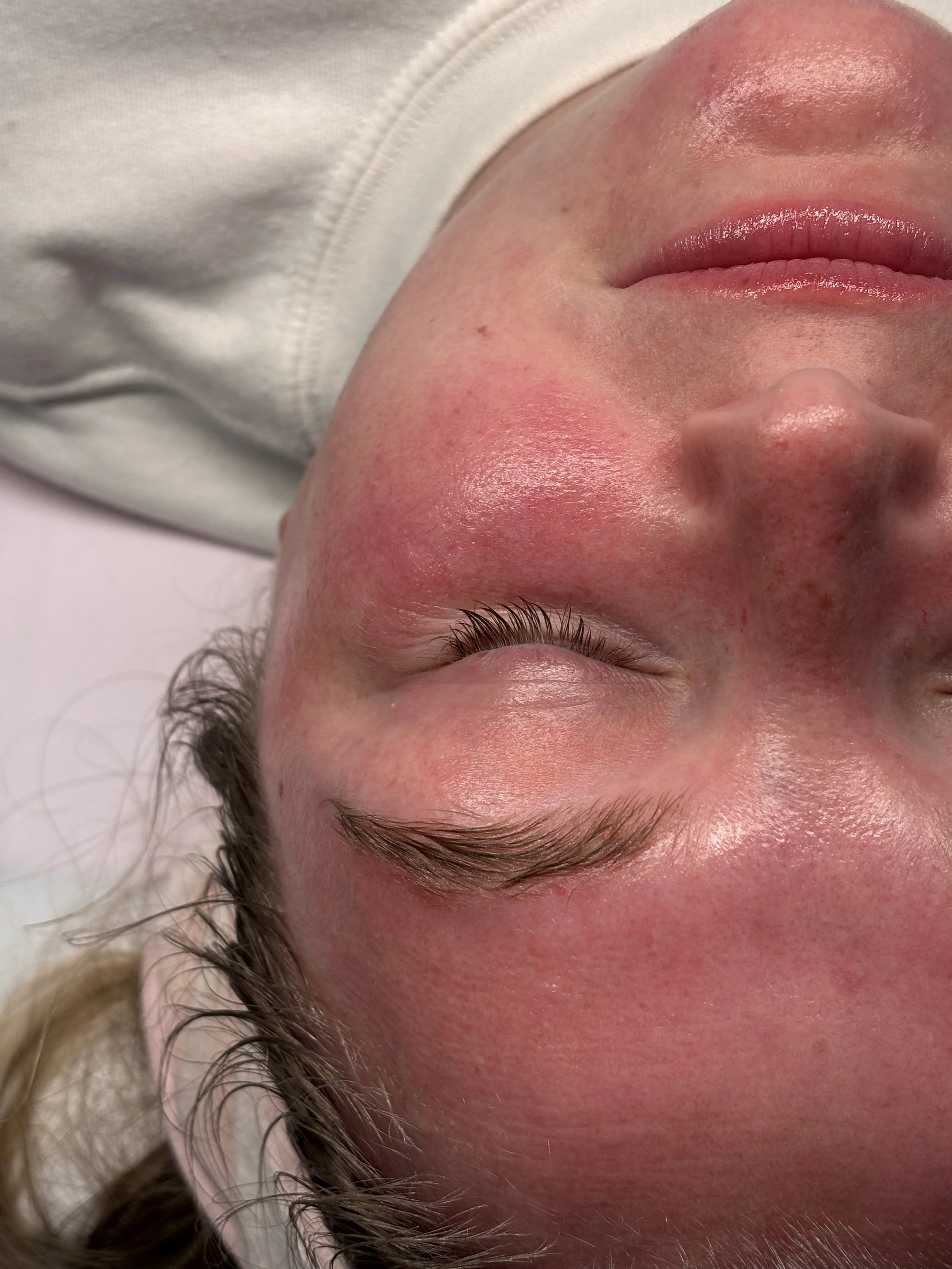 Close-up of a person's face with redness and some skin irritation, lying down with closed eyes.