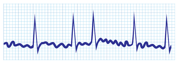 ECG-style illustration of an irregular heart rhythm