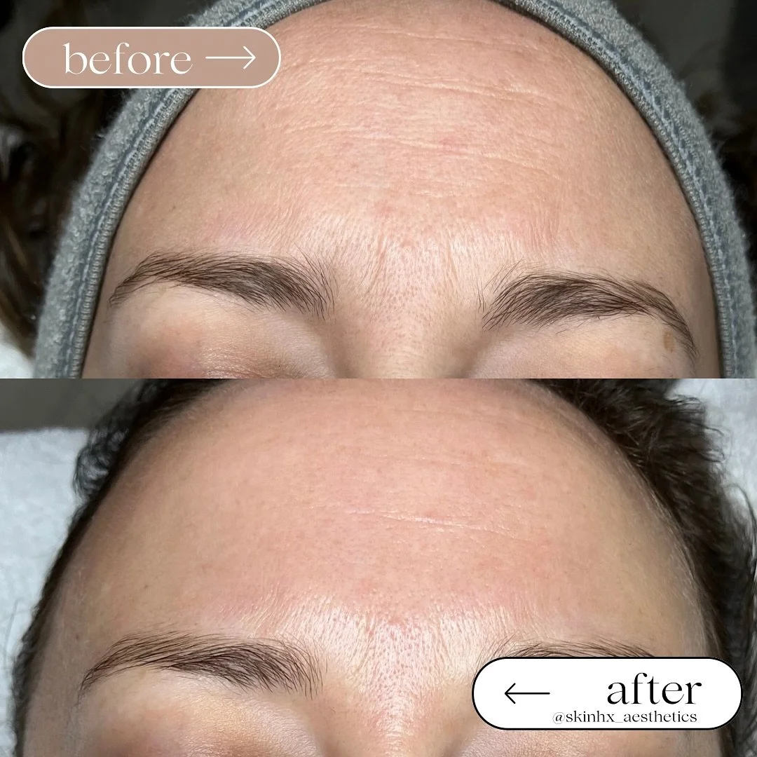💧 Did you know many fine lines are actually dehydration lines? When skin lacks water, lines + wrinkles look deeper than they really are. This was in one treatment&hellip;

This HydroDiamond Facial was all about brightening + softening those lines wh