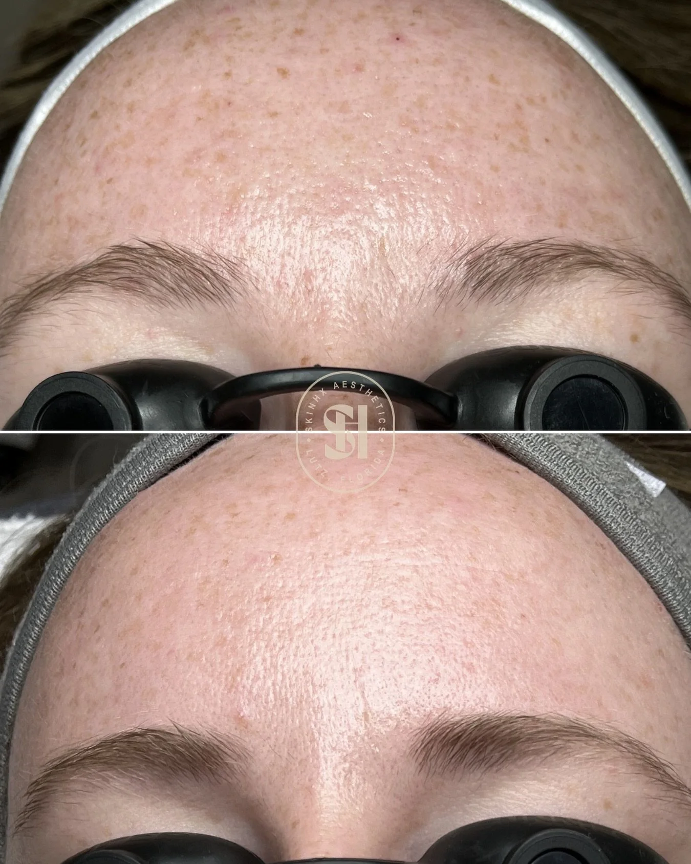 she came in for acne&hellip; but the brightening effect was the bonus ✨

this before + after (forehead focus) shows how much the skin can shift with the right level of correction and consistency

she received my clear skin acne facial, paired with a 