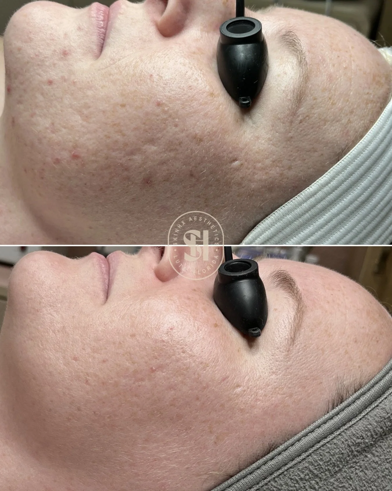 7 months of progress 🫰🏼

the biggest factor in her results was communication. and I will always, always set aside enough time each visit to listen to every detail 🤗

She kept me updated, asked questions, and stayed honest, which allowed me to adju