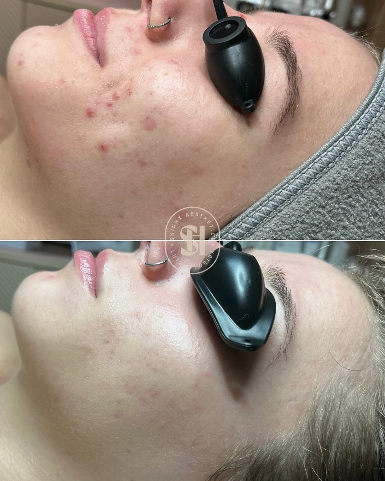 there&rsquo;s nothing better
than guiding you through your acne journey and seeing you feel like yourself again
this is my why, always

xo

#lutzfacials #landolakesfacials #tampafacials #acnespecialist #acnetreatment