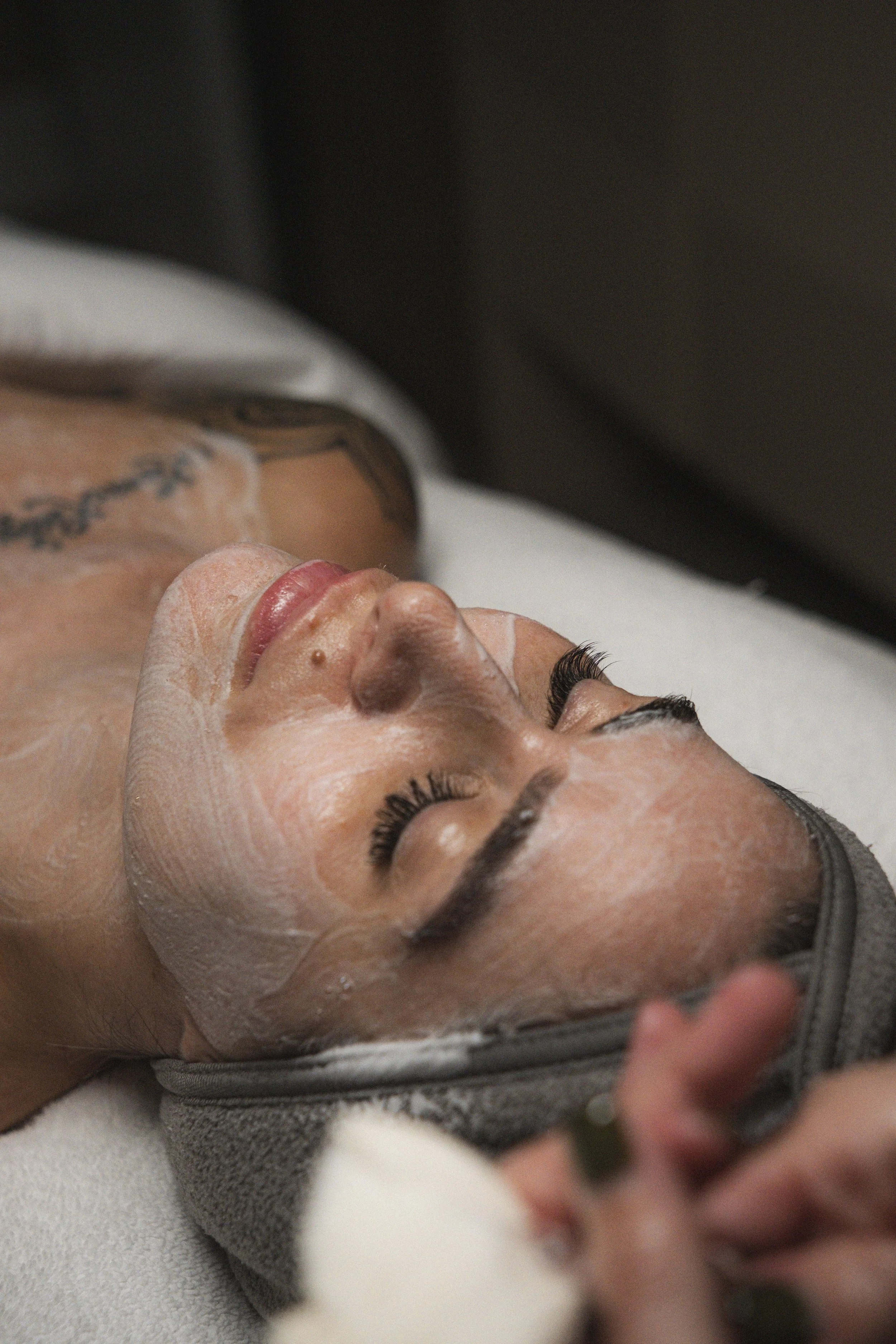 acne treatment tampa