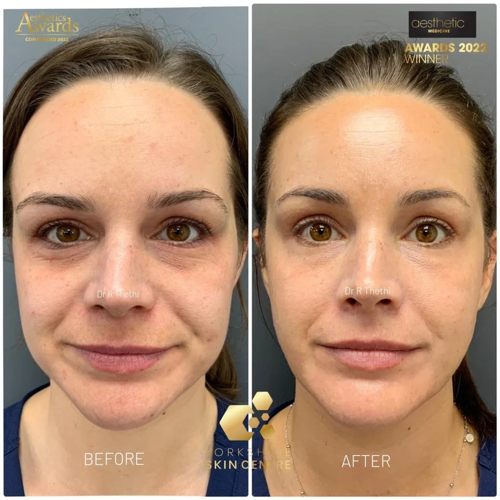 Age 32yo female, 1 treatments, 1.2Joules, 1 month after.jpg
