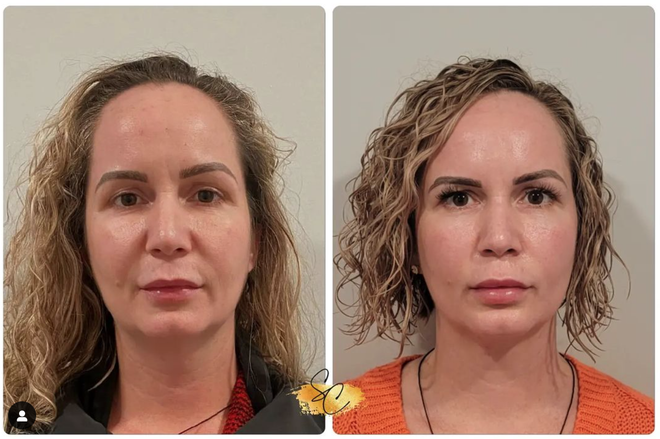 Annie R - Low Energy - Full face_ 0.8J × 2 passes (1.6J total) and Upper cheek_ 3 passes (2.4J total) - 30 days .png