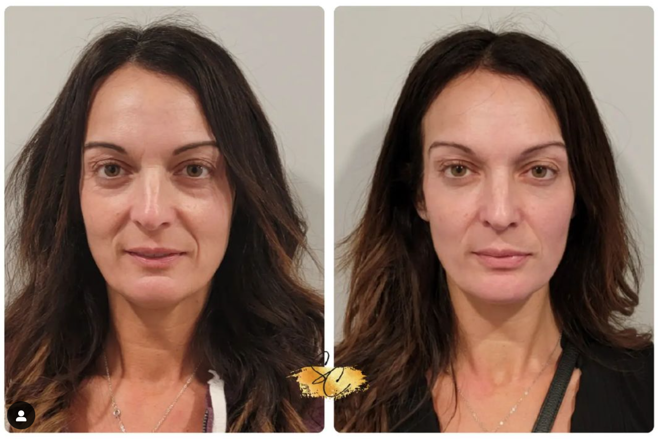 Marisa B -Low Energy - Face treatment - 30 days.png