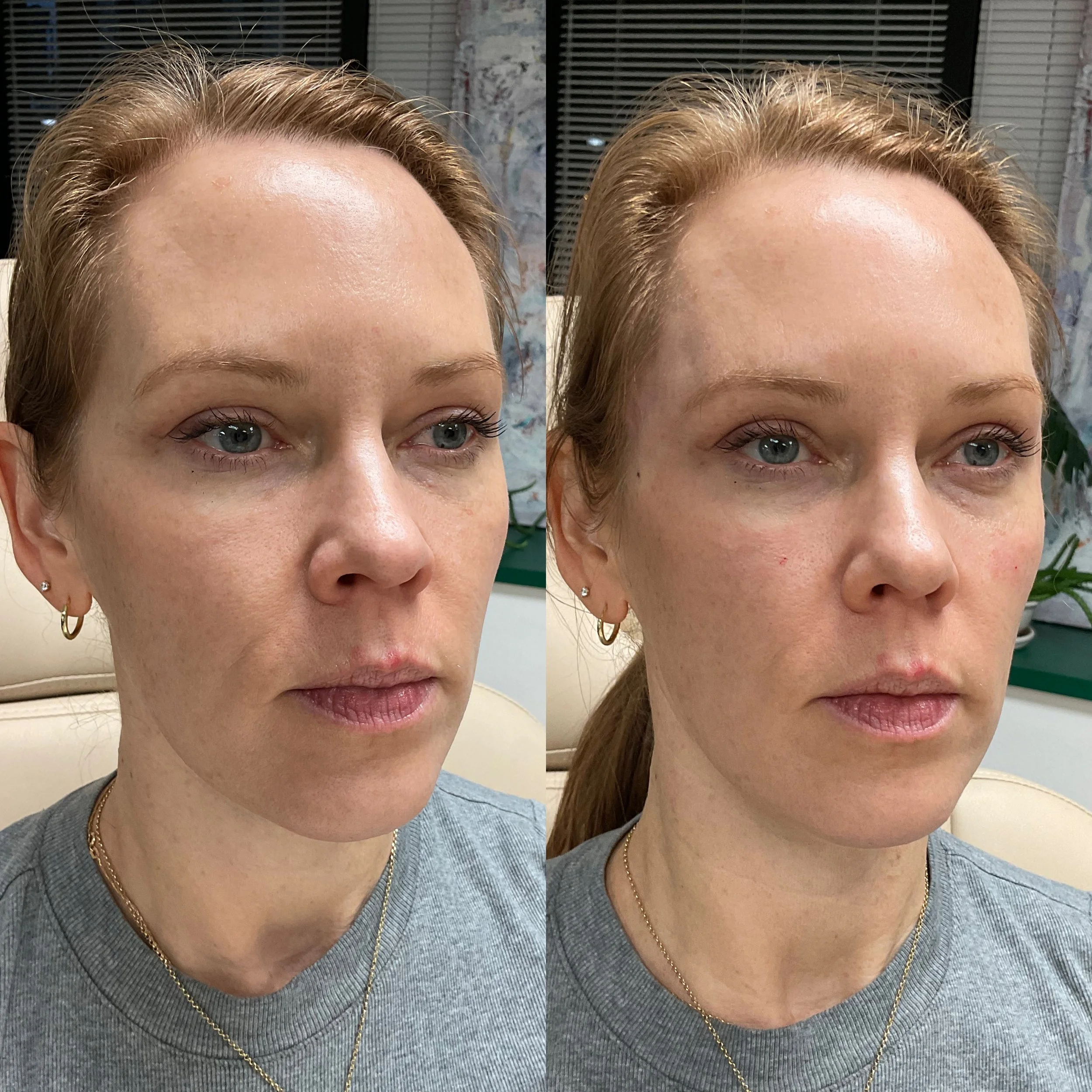 Comparison of a woman's face before and after a cosmetic procedure, showing slight differences in skin texture and facial appearance.