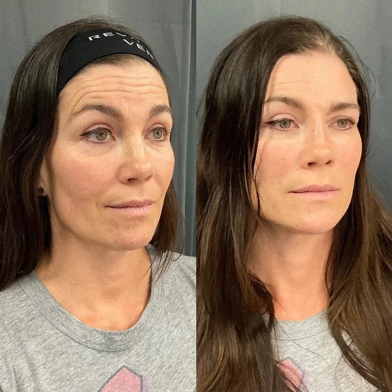 Before and after Thread Lift treatment at Intuition Medical Aesthetics.