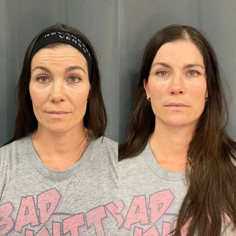 Before and after Thread Lift treatment at Intuition Medical Aesthetics.