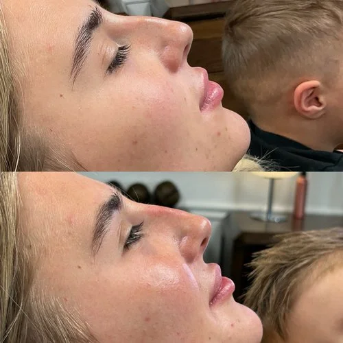 Liquid Rhinoplasty at Intuition Medical Aesthetics in Longmont