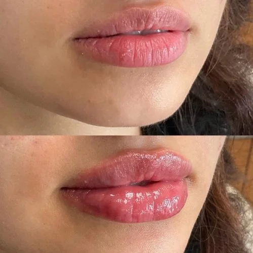 Lip Filler at Intuition Medical Aesthetics in Longmont