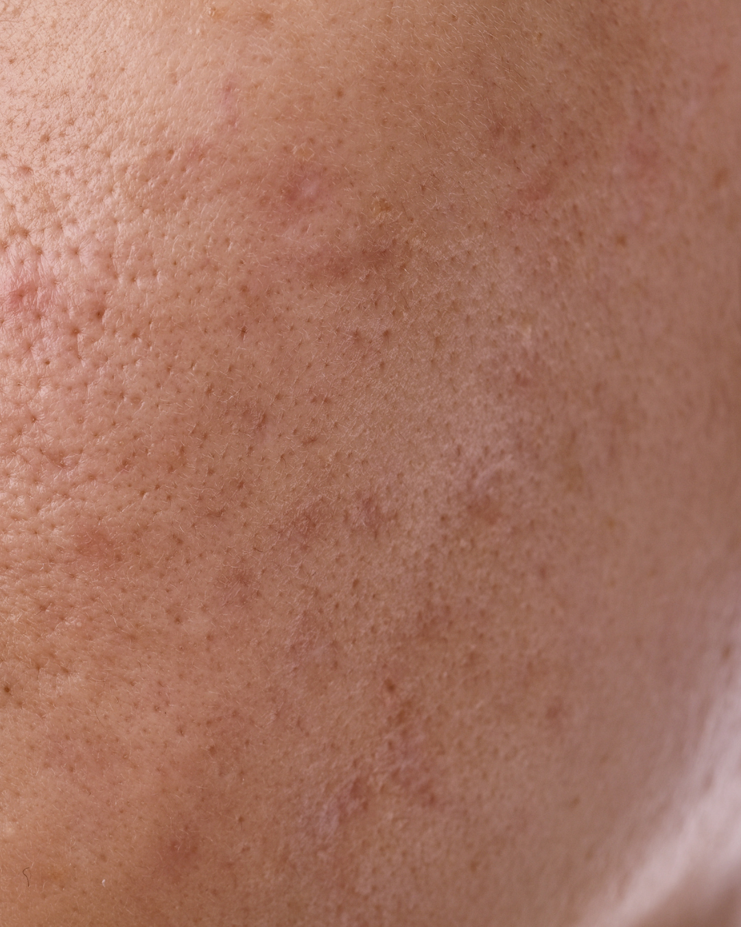 Close-up of human skin showing pores and texture.