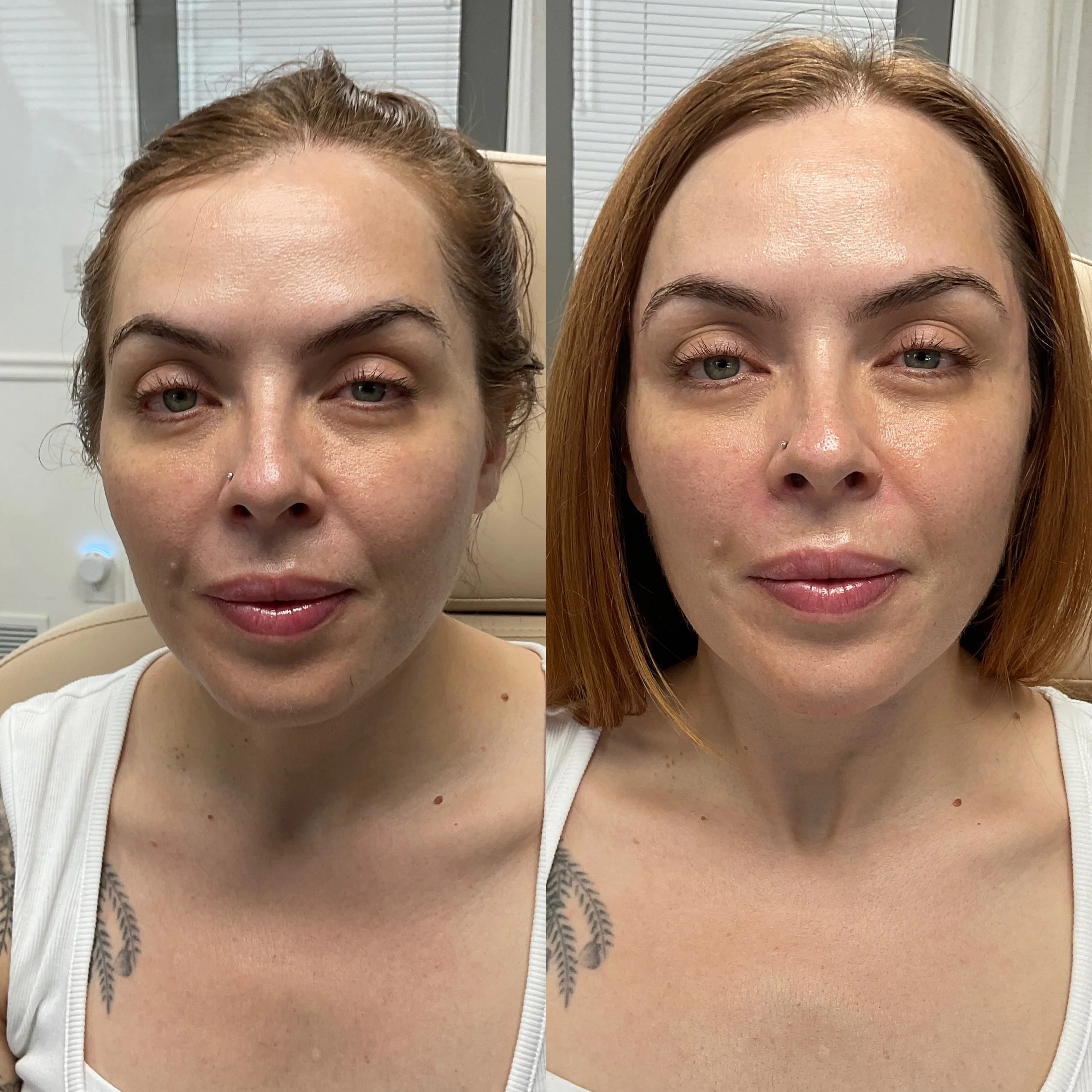 Facial Balancing results at Intuition Medical Aesthetics in Longmont, CO.