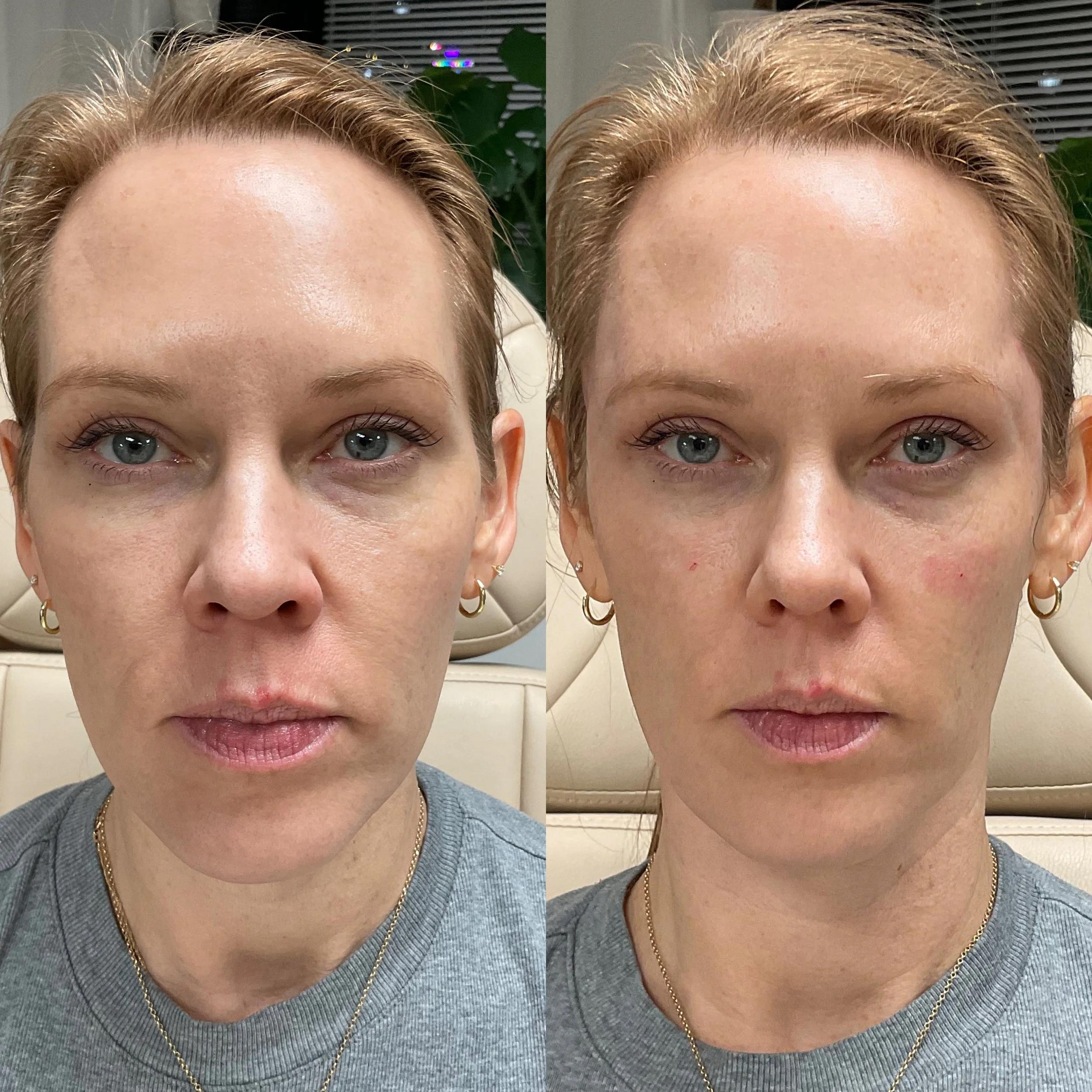Side-by-side comparison of a woman before and after facial treatment, showing improvements in skin texture and appearance.