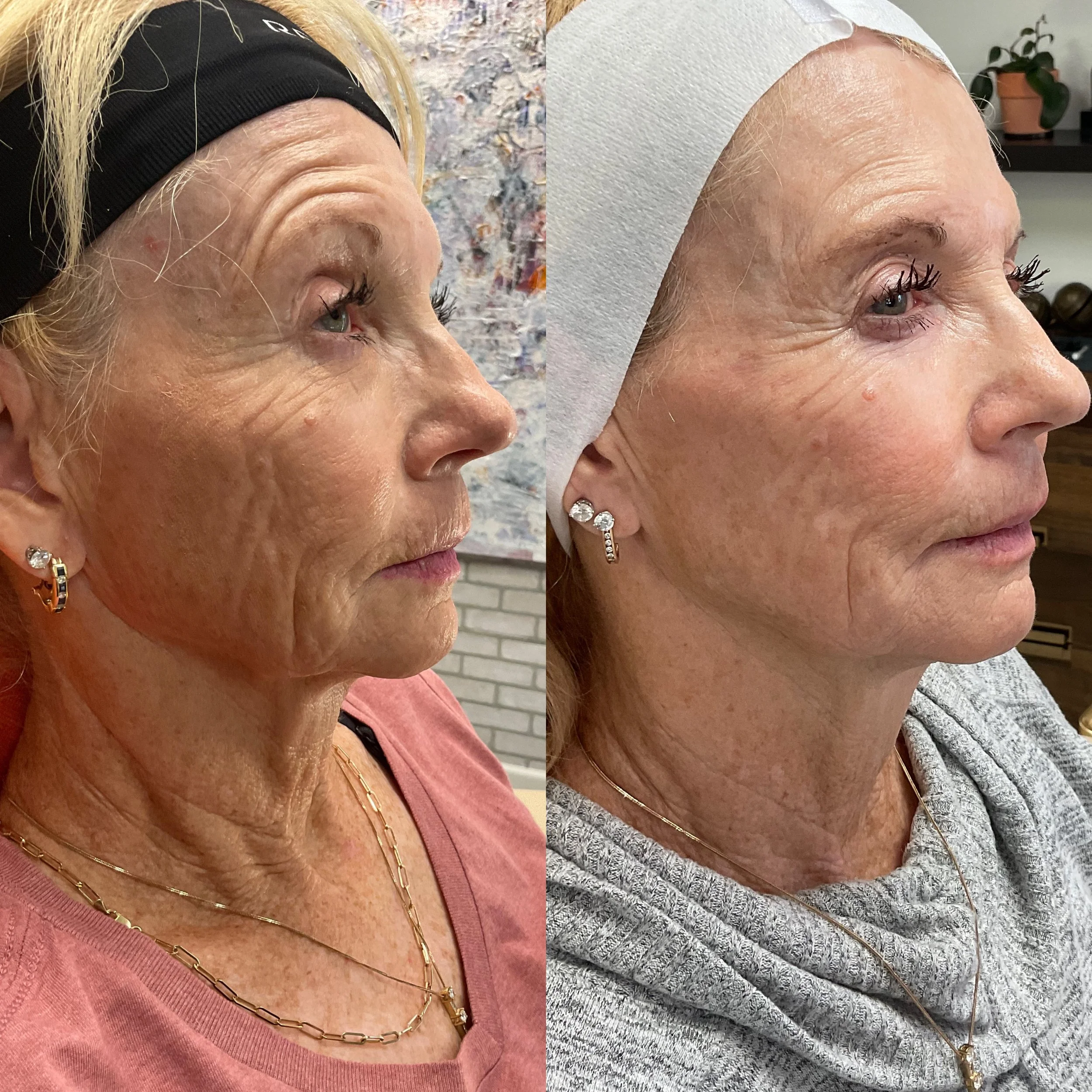Side-by-side comparison of a woman before and after cosmetic treatment, showing smoother skin with fewer wrinkles.
