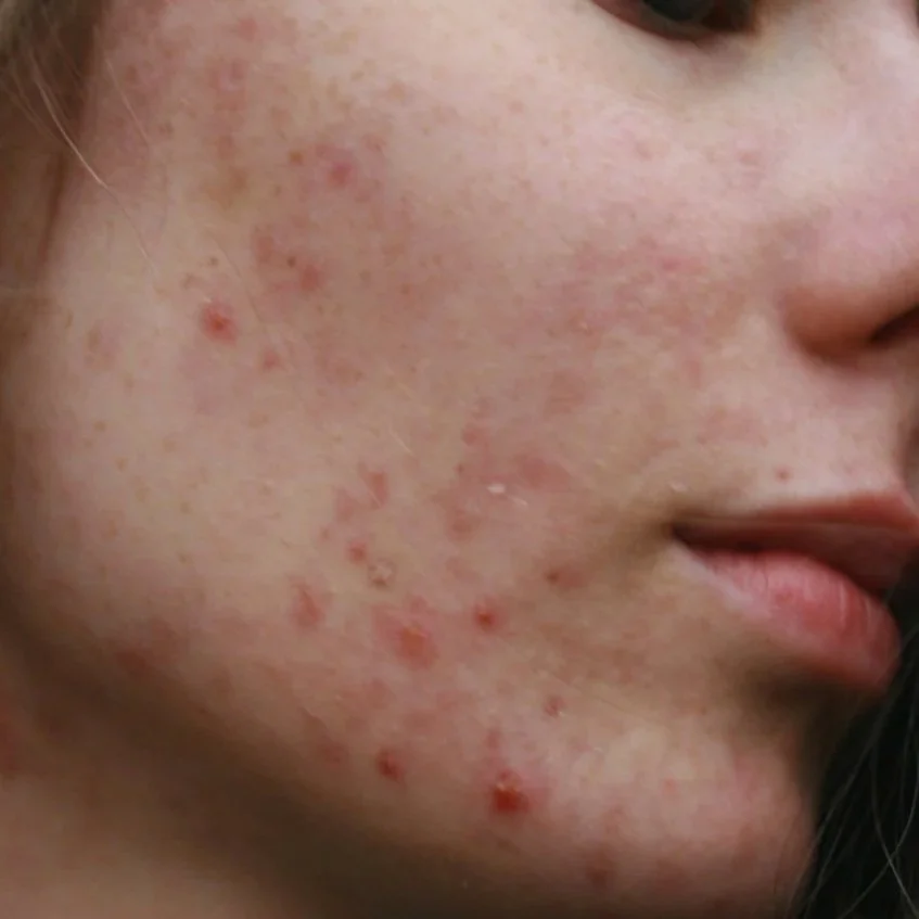 Close-up of a person's face showing red, inflamed acne on cheek and jawline.