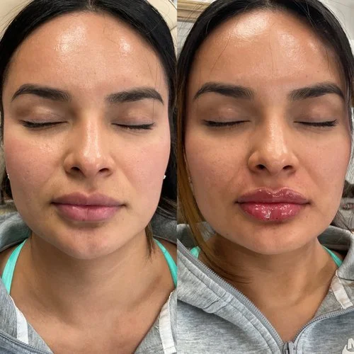 Lip Filler at Intuition Medical Aesthetics in Longmont