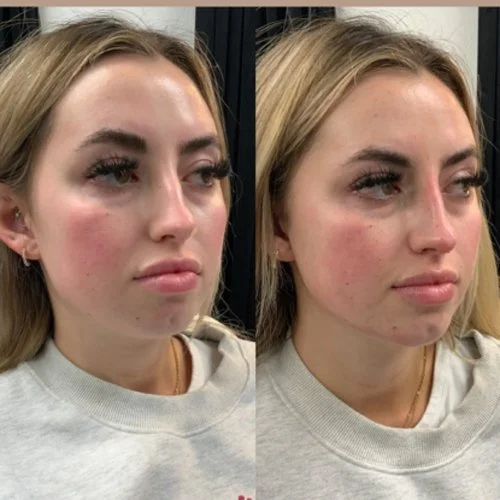 Facial Balancing - Liquid Rhinoplasty and Chin Augmentation at Intuition Medical Aesthetics in Longmont