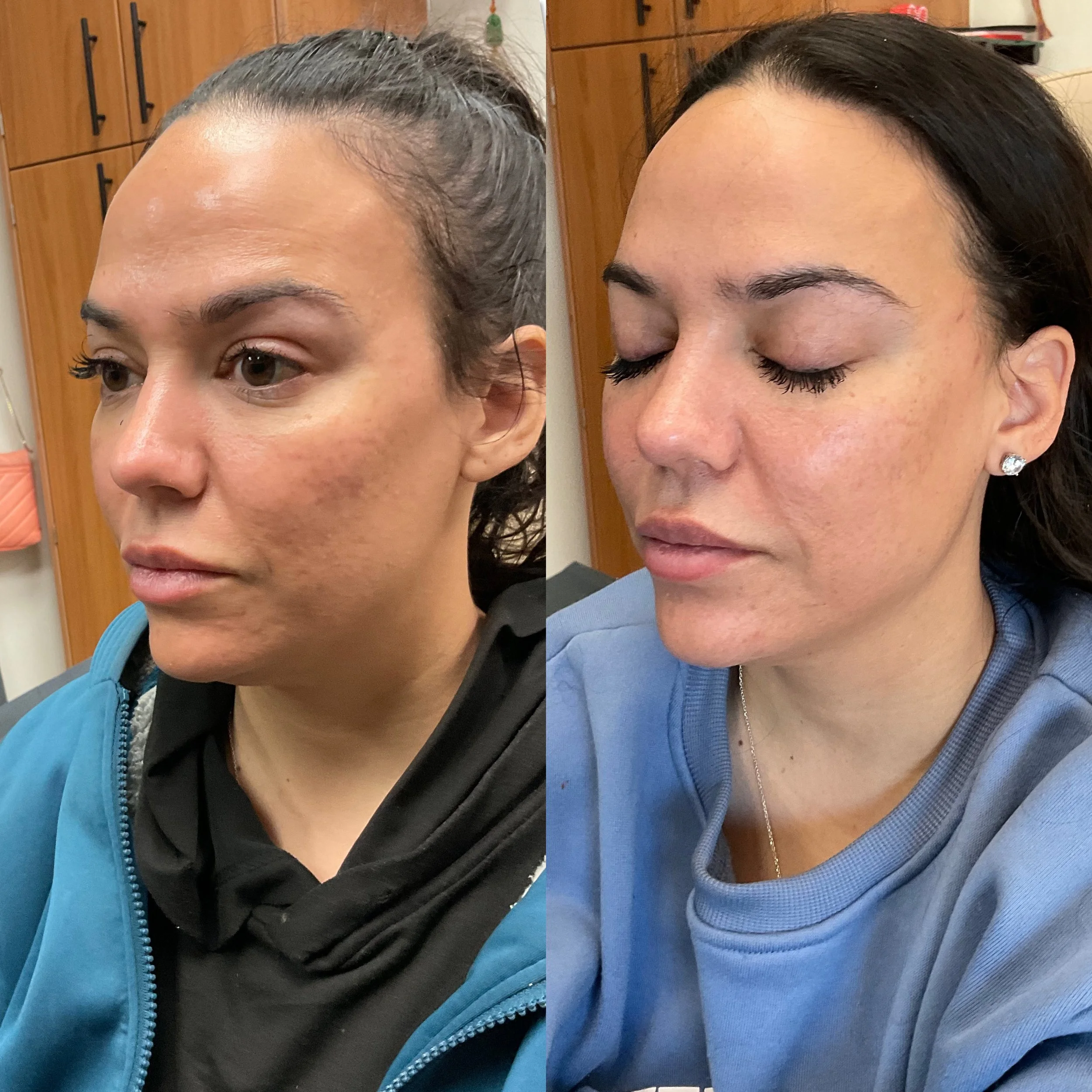 Before and 2 weeks after Thread Lift treatment at Intuition Medical Aesthetics