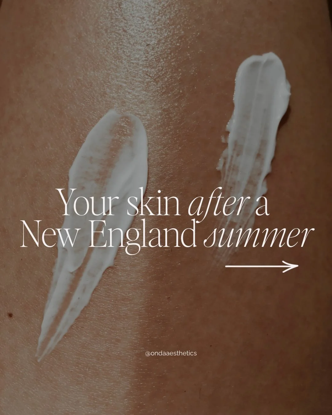 Not every summer skin concern needs the same fix - figuring out which is honestly most of what I do. 

Swipe through the most common things I hear this time of year, translated into what&rsquo;s actually happening underneath. 

Book a consult through