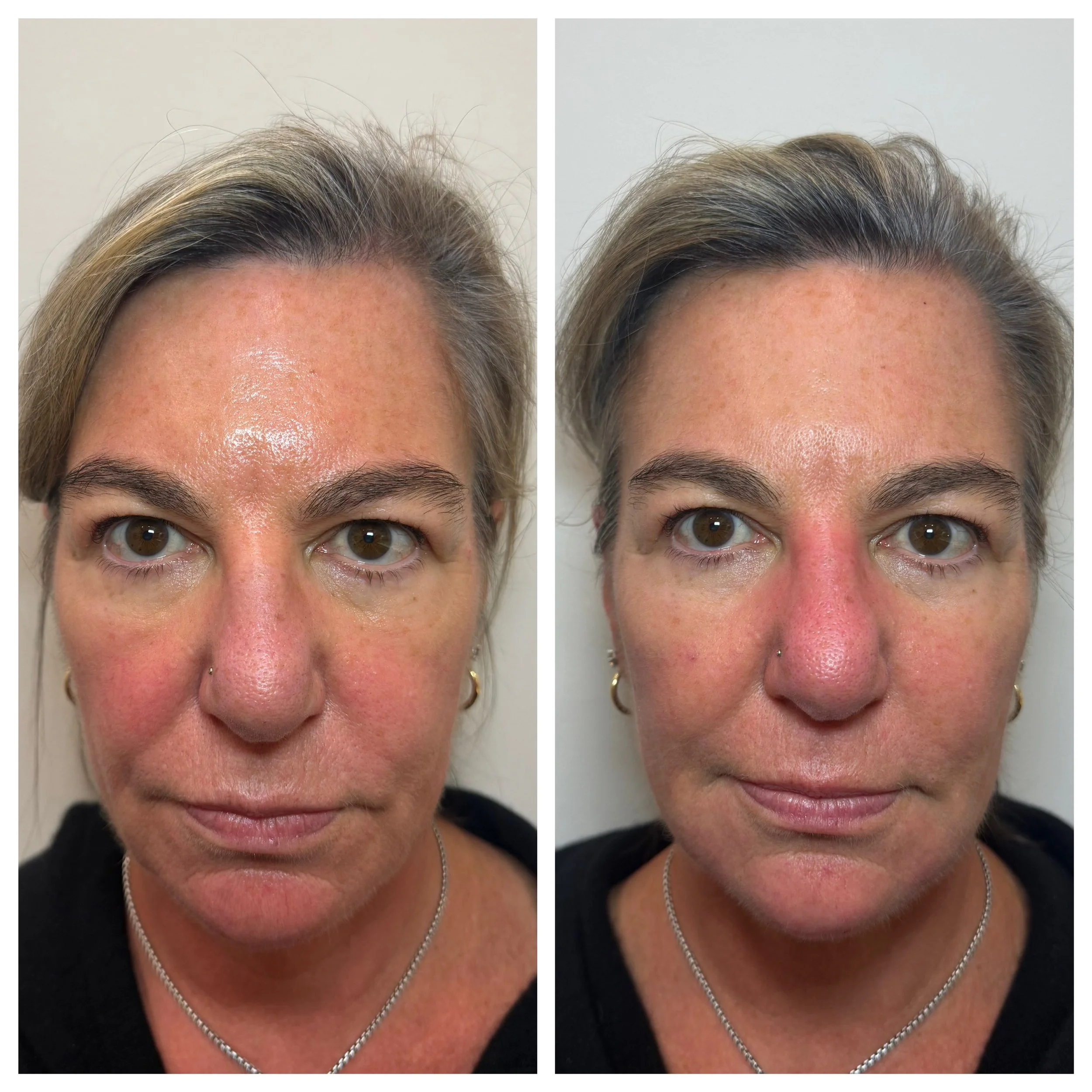 Subtle and refreshed. ✨

Full face Daxxify neurotoxin + Revance HA filler. The Daxxify hasn&rsquo;t kicked in yet, so what you&rsquo;re seeing here is mostly the RHA, with softer shadows and natural-looking support. The Daxxify will smooth things fur