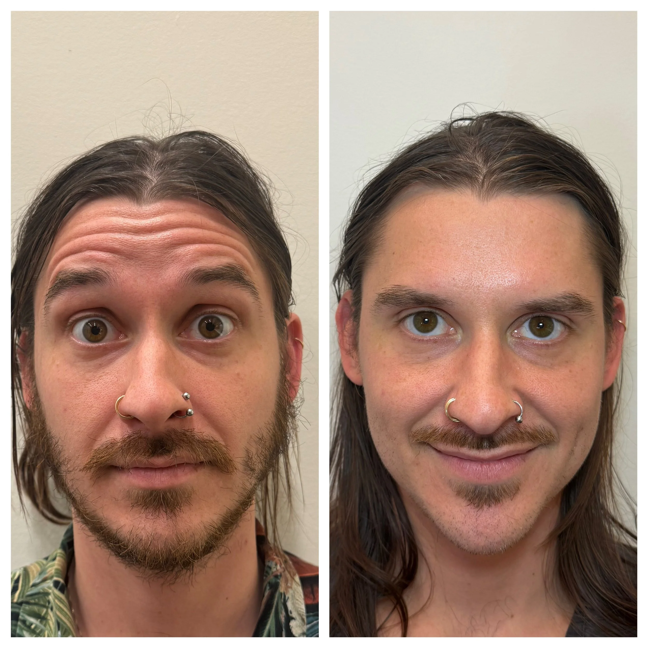 Upper face, softened, not frozen. ✨

Left: before. Right: 1.5 weeks after treatment of the forehead, 11s, and crow&rsquo;s feet.

This patient received 55 units of Botox. The goal was to smooth the lines while keeping strong, natural expression. Same