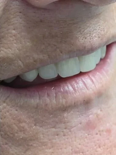 where to get natural dentures in the UK ? answer? Lesica Modern Dentures Chesterfield. Lifelike Denture Teeth, very comfortable dentures for my dad. the best care.