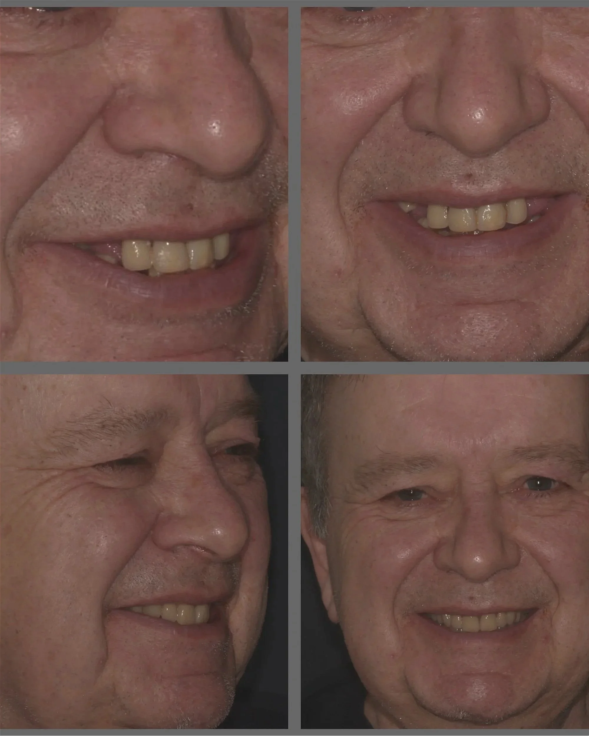 before & after dentures UK, Emilia Lesica modern Dentures Chesterfield Derbyshire UK